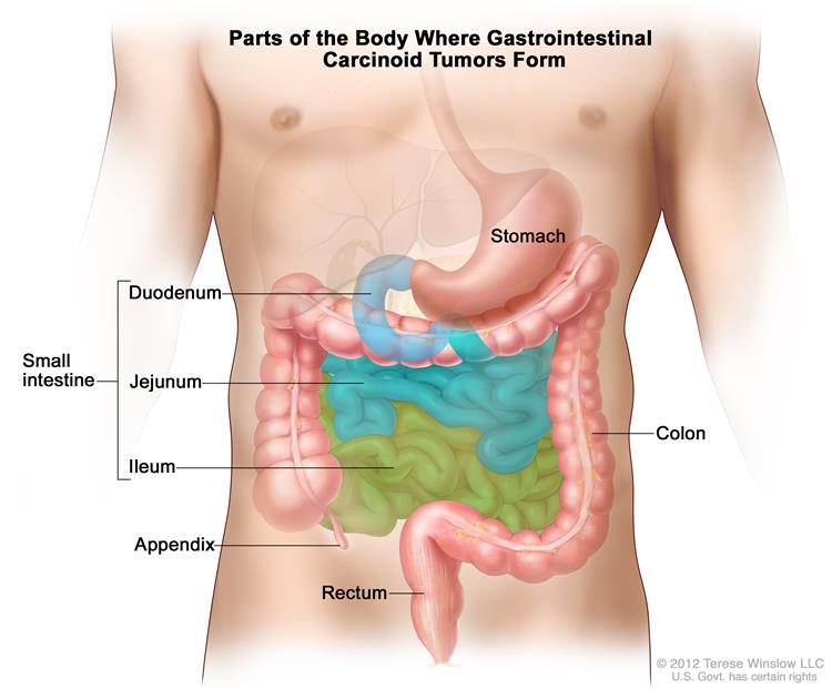 Parts of the body were Gastrointestinal Carcinoid Tumors form.
