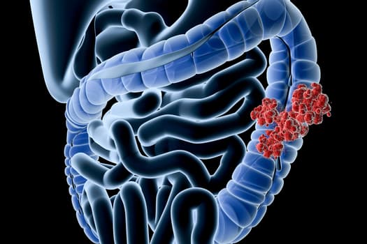 photo of rectal cancer
