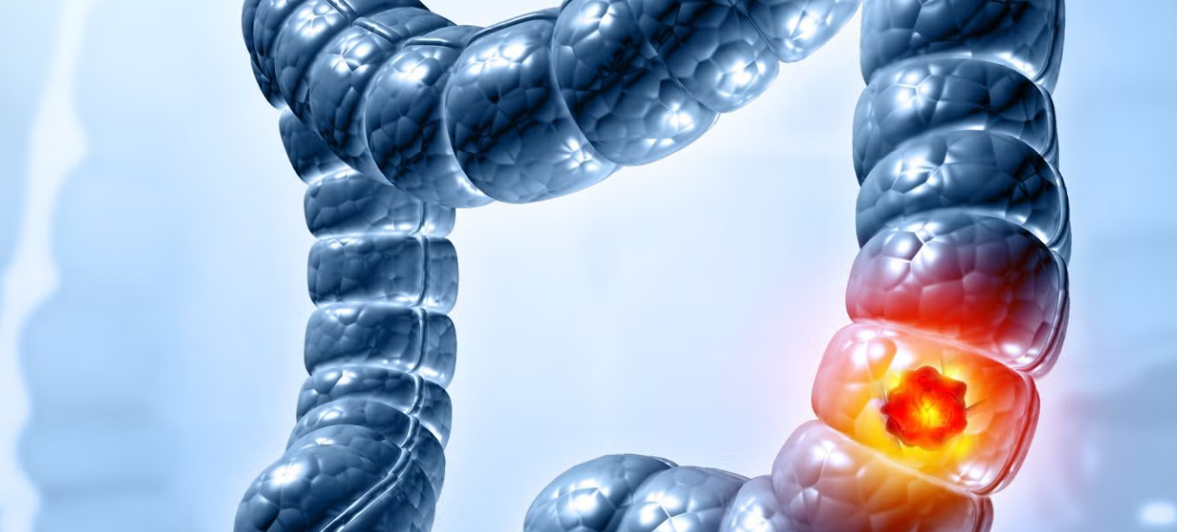Colorectal Cancer Colorectal Cancer